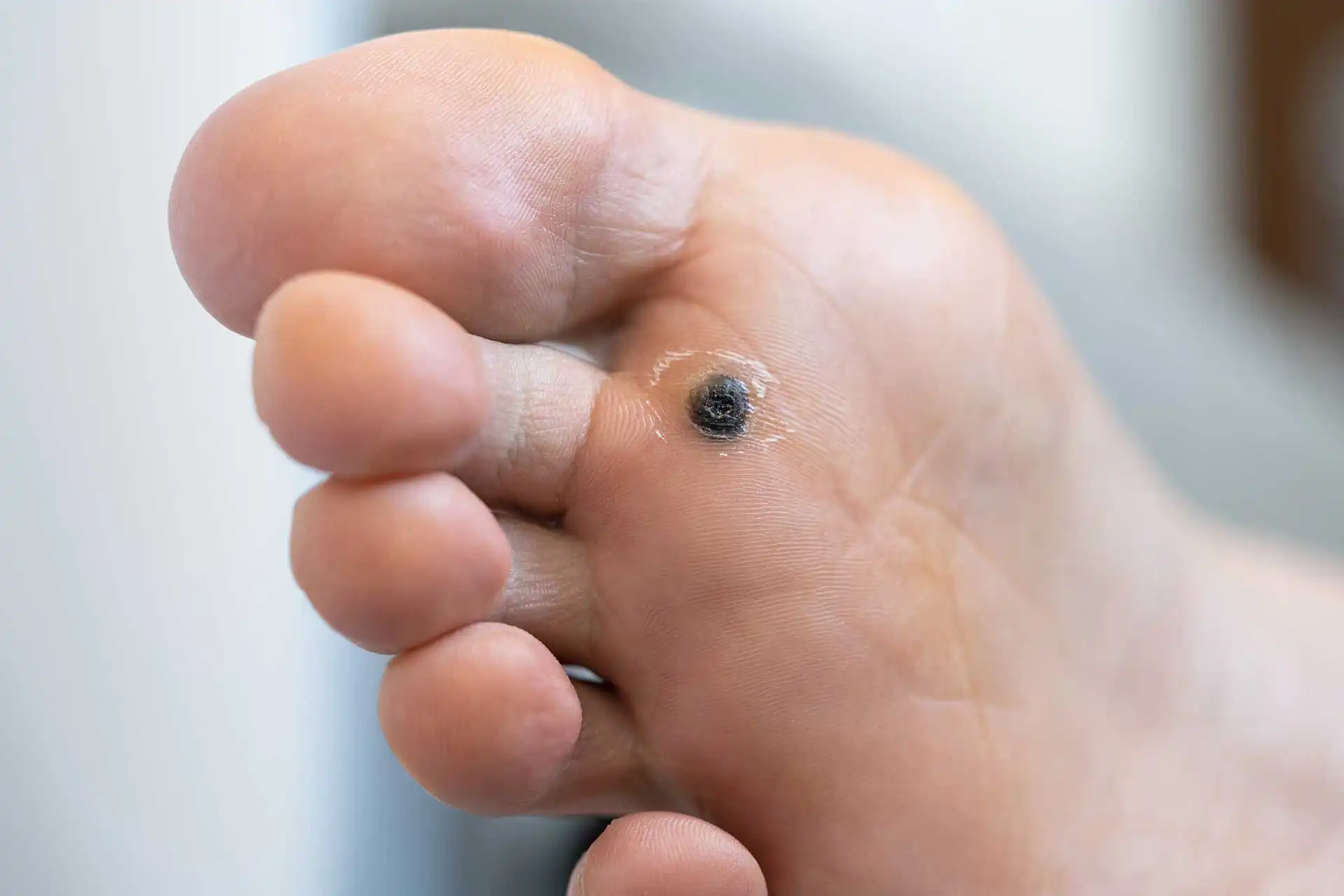Verrucas Warts